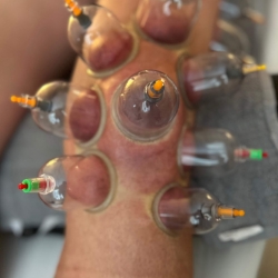 Cupping på knæ i Nordsjælland